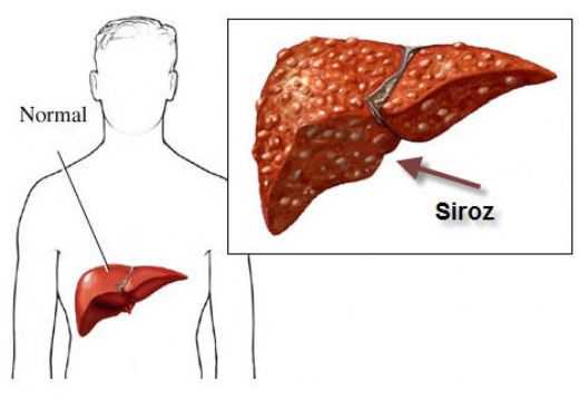 Hepatit B Siroz Belirtileri ve Tedavisi