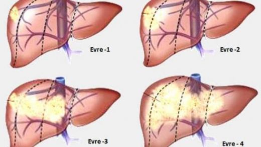 Hepatit Karacier