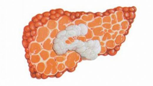 Kronik Hepatit Belirtileri ve Tedavisi