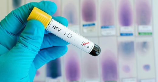 Kronik Viral Hepatit C Belirtileri ve Tedavisi