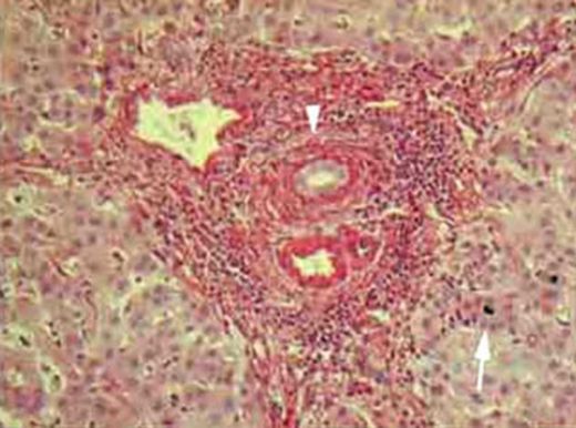 Otoimmün Hepatit Belirtileri ve Tedavisi